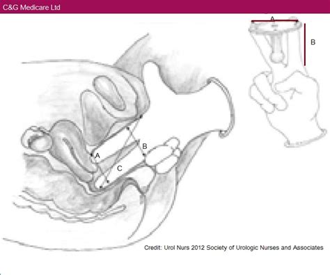 How to measure fitting a pessary - YOUR PESSARY