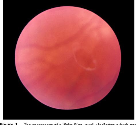 Figure 1 from Current treatment for vitreous floaters. | Semantic Scholar