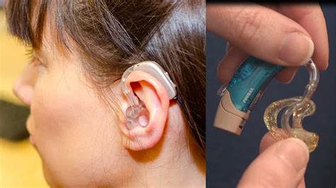 Everything You Need to Know About Hearing Aid Earmolds Vs. Open-Fit Domes