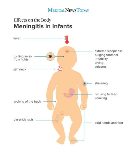 Meningitis Viral Rash Baby / Rashes In Babies And Children Nhs - just ...