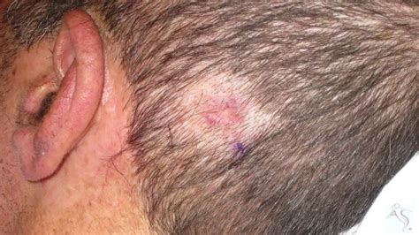 Skin Cancer Bump On Scalp