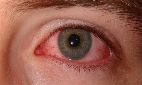 Eye flu cases in Delhi: Doctors advice medical attention