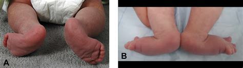 Congenital vertical talus causes, symptoms, diagnosis, treatment ...