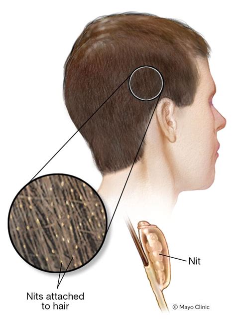 Head lice - Symptoms & causes - Mayo Clinic