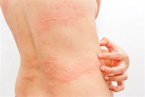 Allergy to gel polish (32 photos): symptoms and causes, list of ...