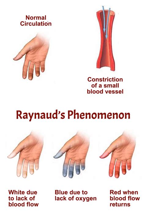 Raynaud’s Phenomenon | APS Foundation of America, Inc.