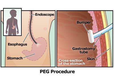 Gastrostomy Tube (G-Tube) (for Parents) - Norton Children's