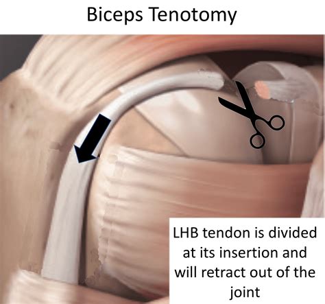 Bicep Release Surgery at gansantinoblog Blog