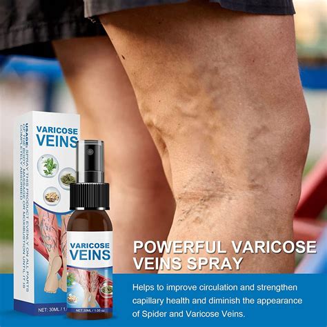 Varicose Veins Miracle Spray: Treatment for Legs to Improve Blood ...