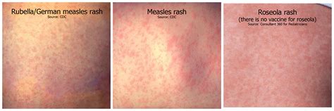 Rubella as related to German Measles - Pictures