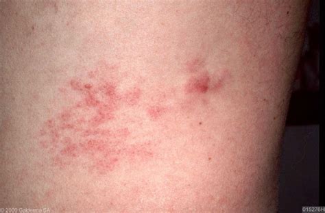 T Cell Lymphoma Rash Lymphoma T Cell Cutaneous T Cell Lymphoma | Images ...