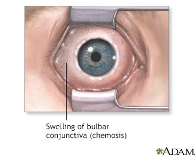 HIE Multimedia - Chemosis