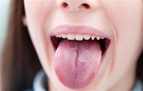 Geographic Tongue: 10 Causes of Geographic Tongue