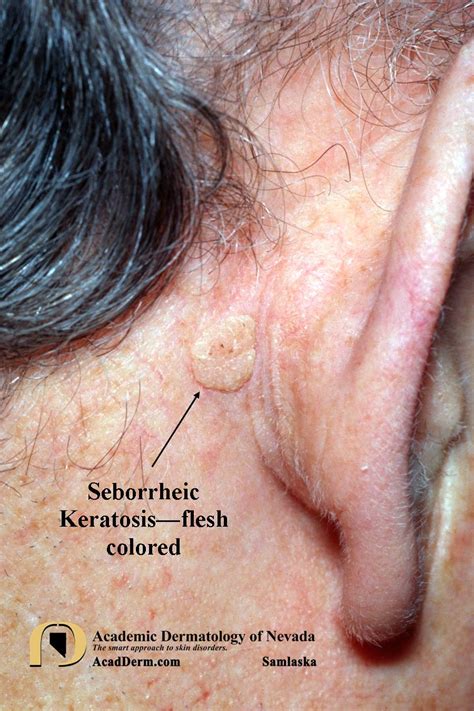 Seborrheic Keratosis: Atypical Forms... - Academic Dermatology of Nevada