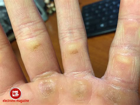 How To Get Rid of Calluses on Hands | WOD Welder