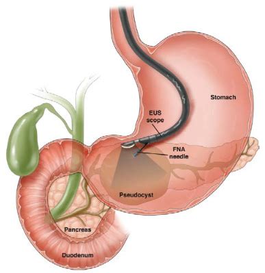 Endoscopic ultrasound (EUS) - AGA GI Patient Center