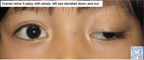 Cranial Nerve 3 Palsy