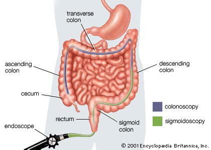 Sigmoidoscopy | Colon Cancer Screening, Diagnosis & Treatment | Britannica