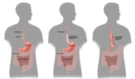 Best Esophageal Surgery hospital in chennai | SIMS Hospital