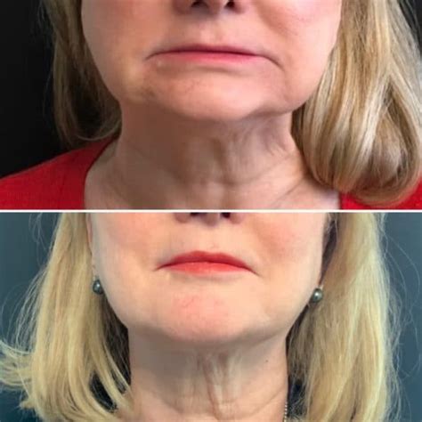 Can Fillers Fix Sagging Jowls | Dallas Dermatology Partners