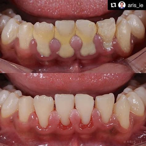 Dr @aris_ie with a kickass #beforeandafter calculus removal ...