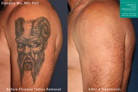 כניסה למחוק תירגע laser tattoo removal results אוטומטי תחום פורה