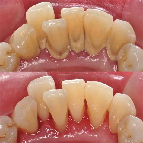 Teeth scaling is removing the tartar deposits from the teeth with the ...