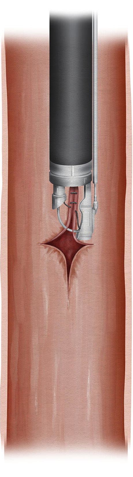 Endoscopic suturing device placing consecutive sutures to close ...