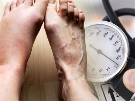 High Blood Pressure Symptoms: 10 Signs That Can Appear In Your Legs and ...