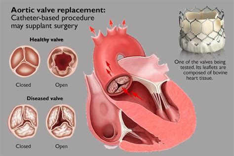 AORTIC VALVE REPLACEMENT HOSPITAL IN PCMC,PUNE - 7 Orange Hospital ...