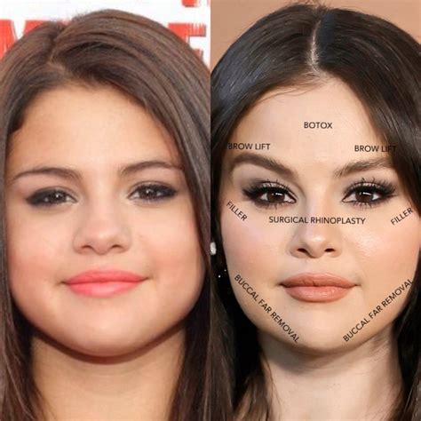 Selena gomez before and after plastic surgery | Botox fillers, Botox ...