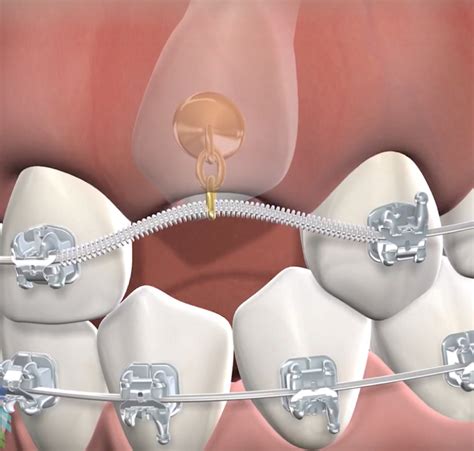 Impacted Tooth Exposure in Norton Shores, MI | Breakwater Oral ...