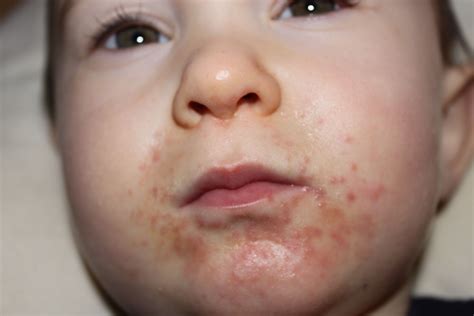 Skin Rashes For Kids