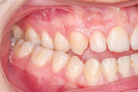 Crossbite: Types, Causes, and Correction Methods - BeSeen