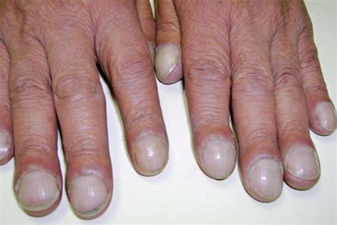 Finger Clubbing: Symptoms, Causes, Diagnosis, and Treatment