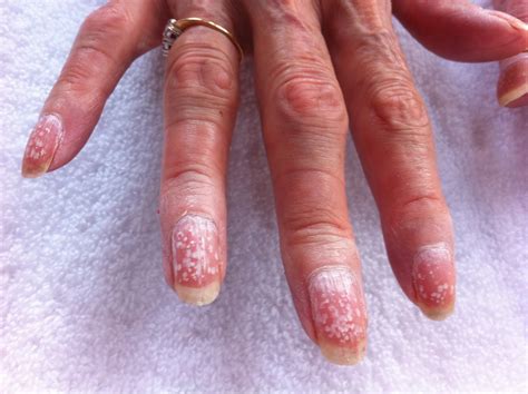 Allergy to gel polish (32 photos): symptoms and causes, list of ...