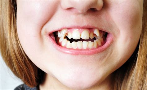 Brits Say Goodbye to the Bad British Teeth Myth | SymbeoHealth