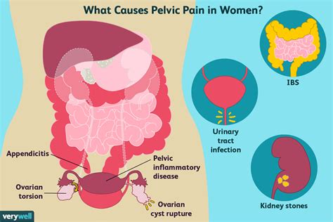 Pelvic Pain: Where It’s Located, Symptoms, Causes and More