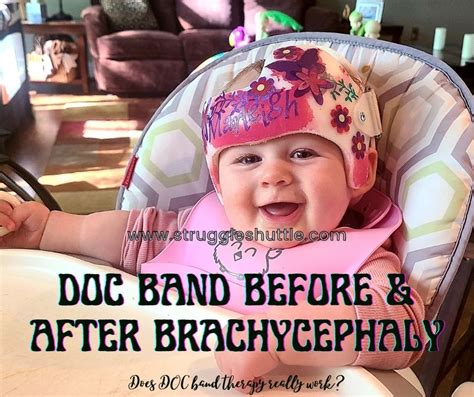 Doc Band Before and After | Brachycephaly - Struggle Shuttle