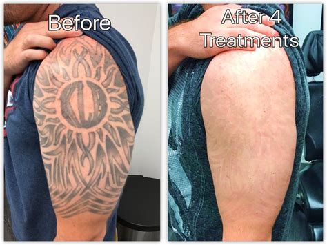 full sleeve tattoo removal before and after - fromfrejatofreya