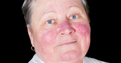 Malar rash: Causes, symptoms, and treatment