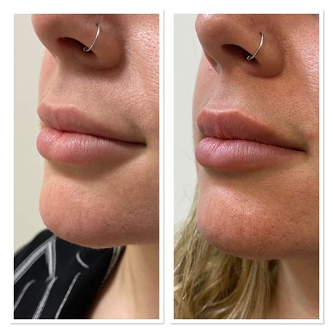 Botox Lip Flip Before & After - NO FILLER : r/PlasticSurgery