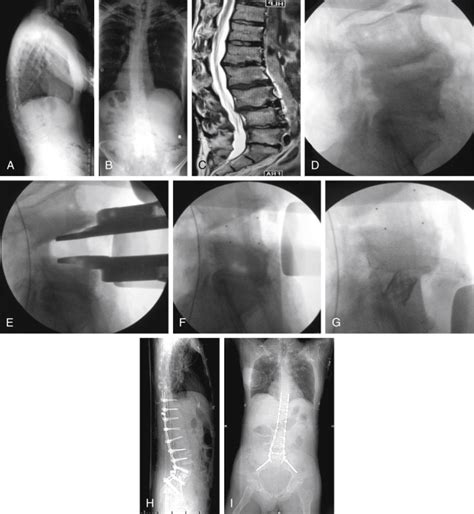 L1-S1 Fusion: When to Extend to T12 and Pelvis and When to Include L5 ...