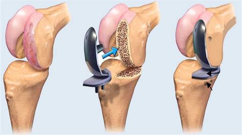 What's A Knee Replacement Surgery Performed At Orthopedic Hospital in ...