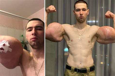 Russian bodybuilder with 24-inch oil-injected Popeye biceps has surgery ...