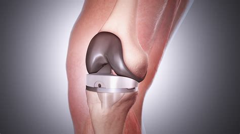 Knee Replacement Surgery: The most popular orthopedic procedure