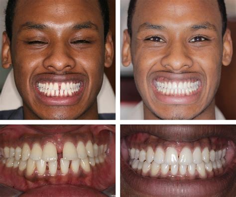 Invisalign Invisible Braces - Central London W1, UK - Harley Street ...