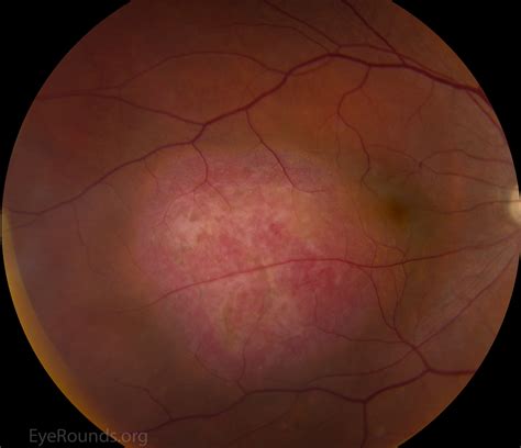 Atlas Entry - Circumscribed choroidal hemangioma