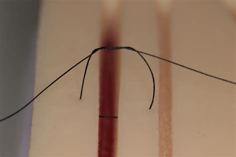 An Overview of Suturing in Dentistry