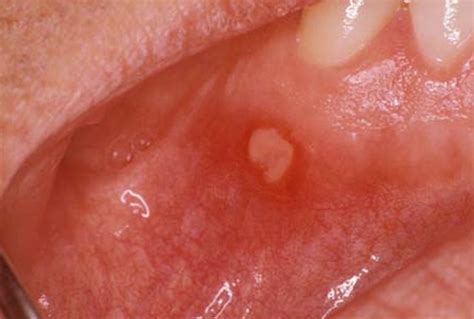 Aphthous Ulcer - Pictures, Home Remedies, Causes, Treatment